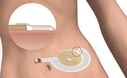 Medical-adhesive-tape-application-ostomy-leak-detection-sensor
