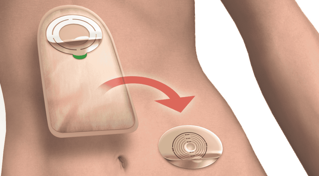 Application-medical-adhesive-tape-application-ostomy-base-plate-top-cover-fixation