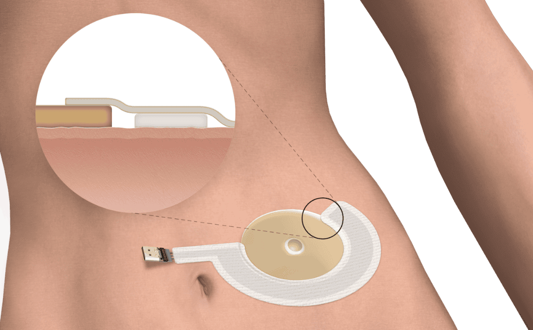 Medical-adhesive-tape-application-ostomy-leak-detection-sensor-cropped