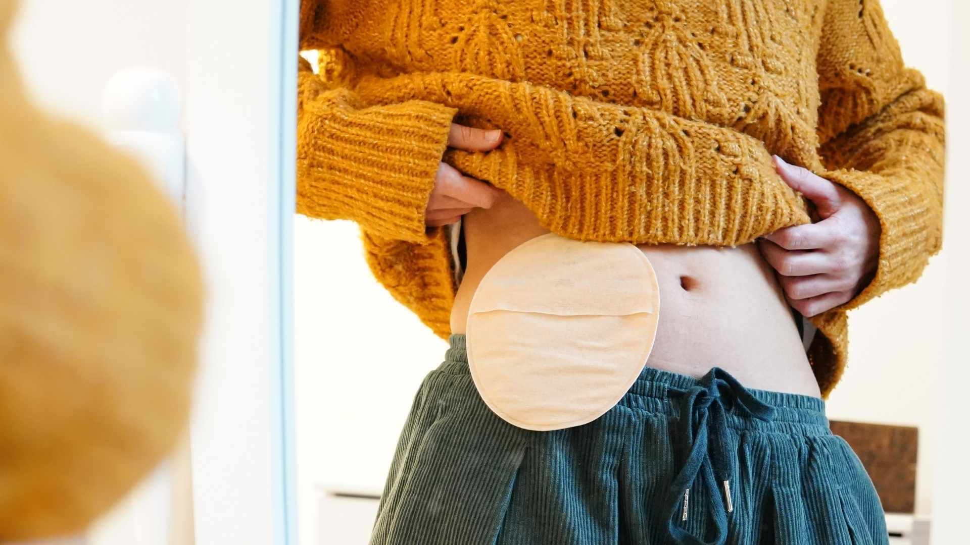 Medical-adhesive-tapes-woman-in-front-of-mirror-with-ostomy-bag